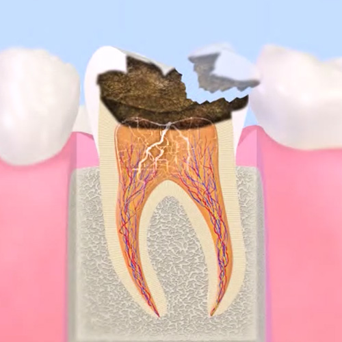 歯髄まで進行したむし歯