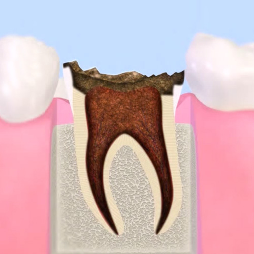 歯質が失われた歯
