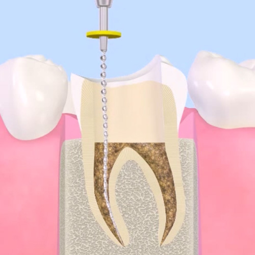 歯の根の治療