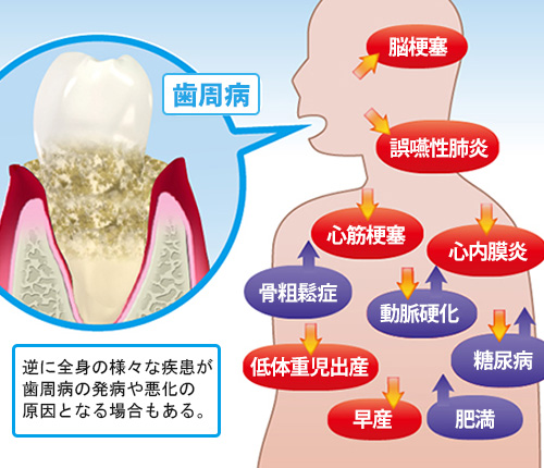 歯周病と全身疾患との関係