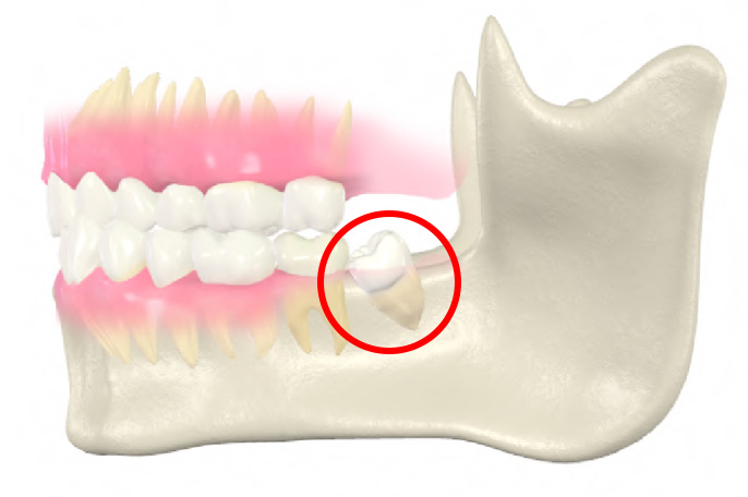 親知らずの抜歯